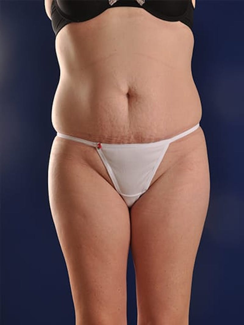 Abdominoplasty / Tummy Tuck Before & After Gallery - Patient 18264531 - Image 1