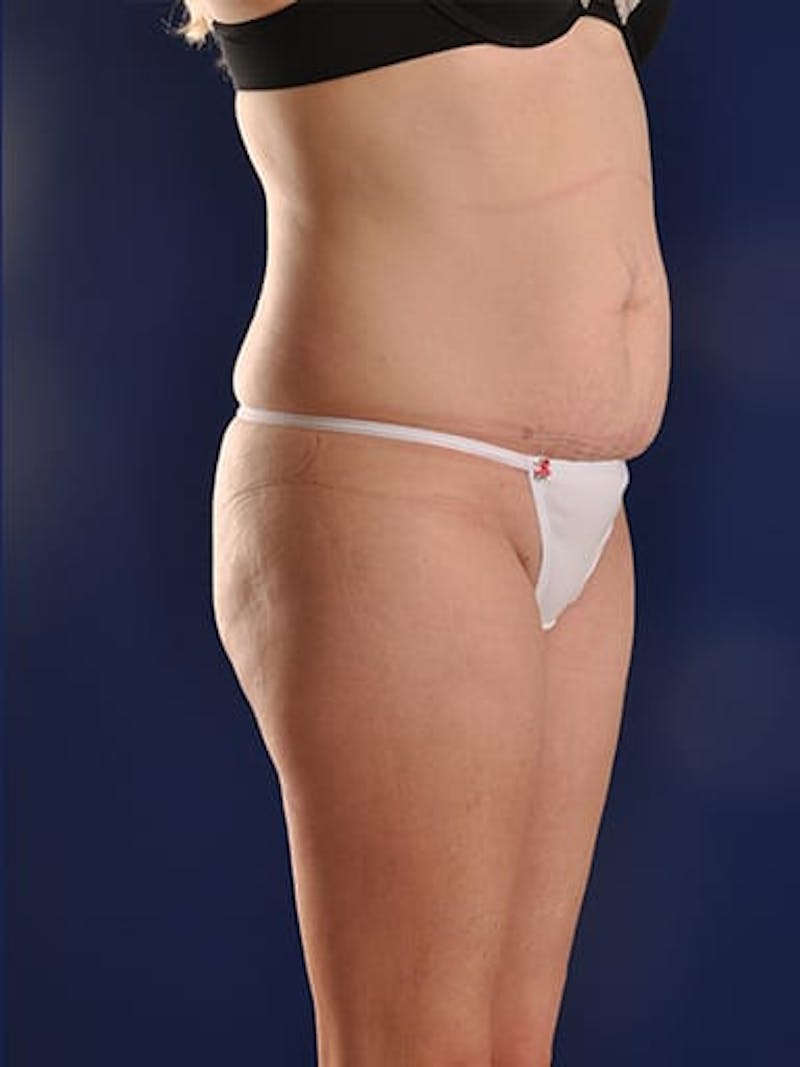 Abdominoplasty / Tummy Tuck Before & After Gallery - Patient 18264531 - Image 3