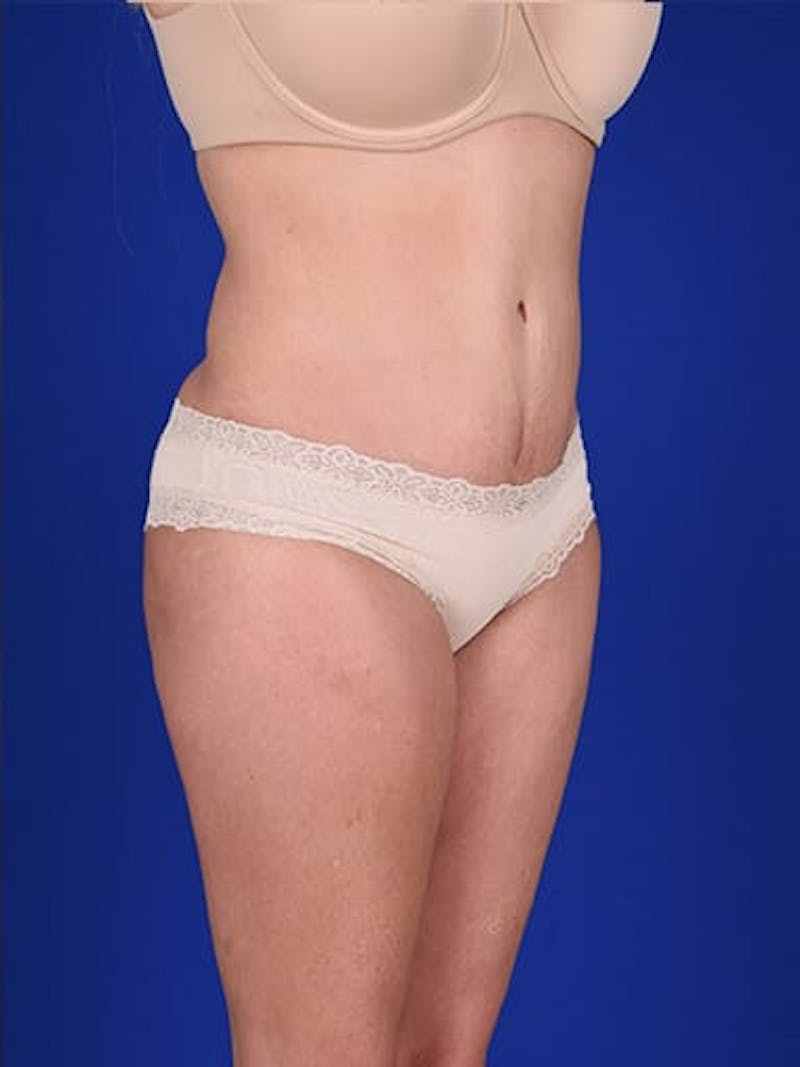 Abdominoplasty / Tummy Tuck Before & After Gallery - Patient 18264531 - Image 4
