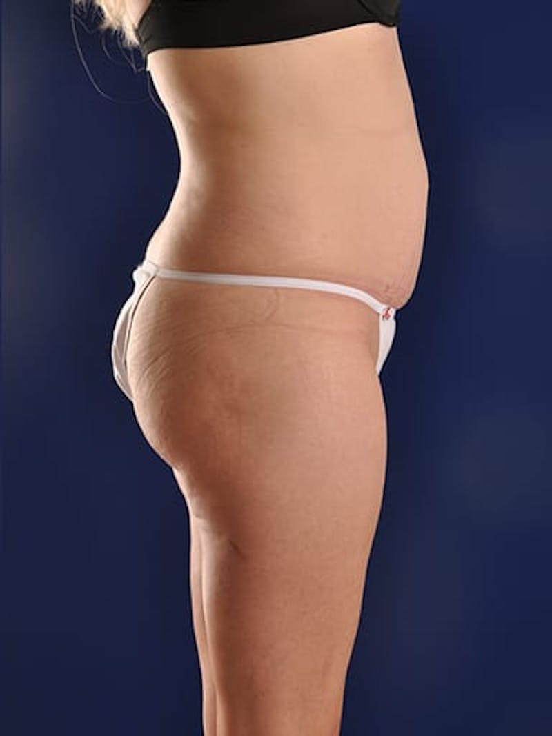 Abdominoplasty / Tummy Tuck Before & After Gallery - Patient 18264531 - Image 5