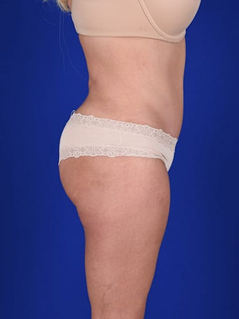 Abdominoplasty / Tummy Tuck Before & After Gallery - Patient 18264531 - Image 6