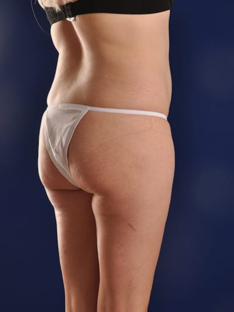 Abdominoplasty / Tummy Tuck Before & After Gallery - Patient 18264531 - Image 7