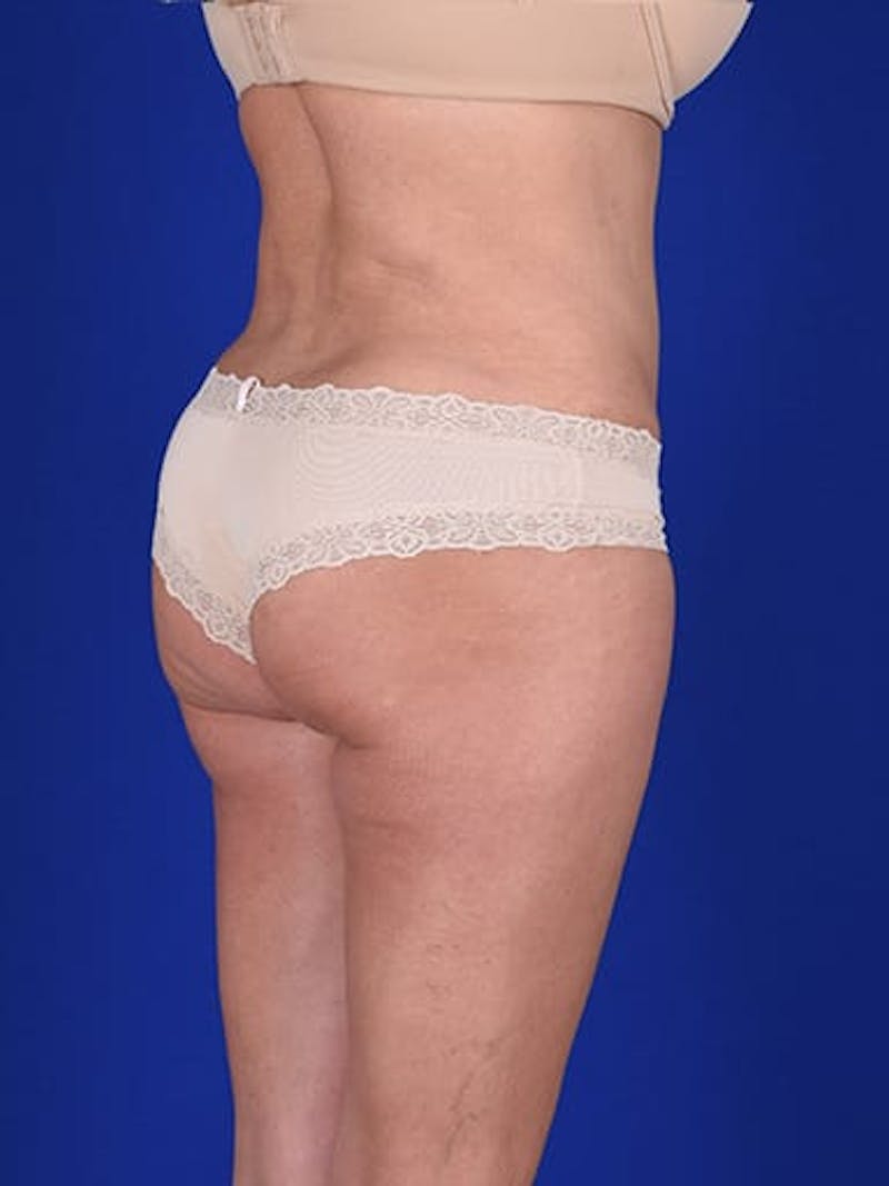Abdominoplasty / Tummy Tuck Before & After Gallery - Patient 18264531 - Image 8