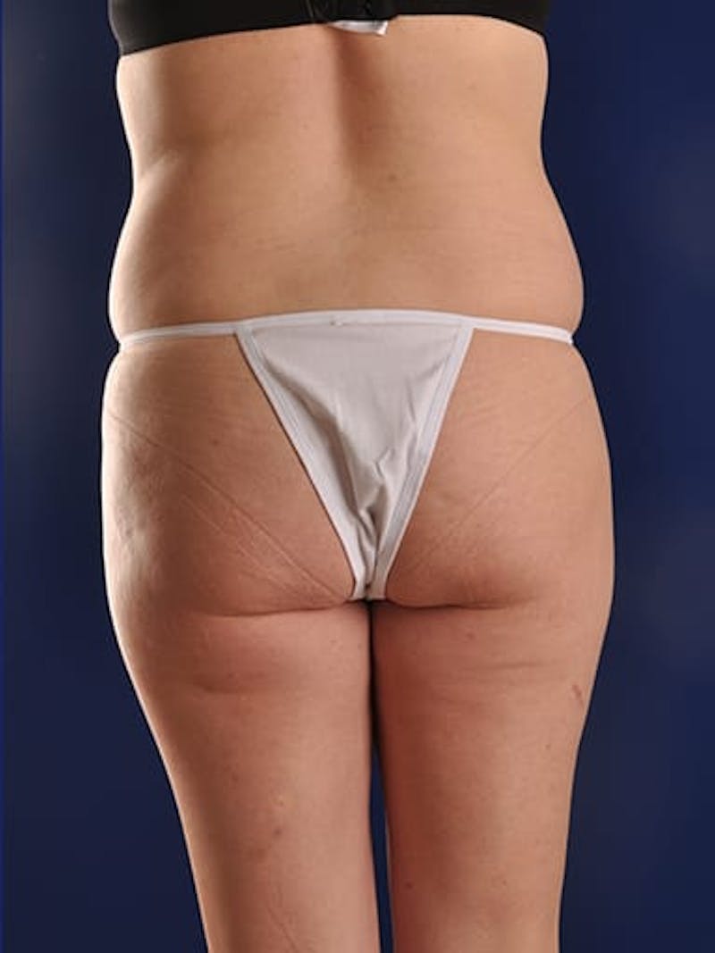 Abdominoplasty / Tummy Tuck Before & After Gallery - Patient 18264531 - Image 9