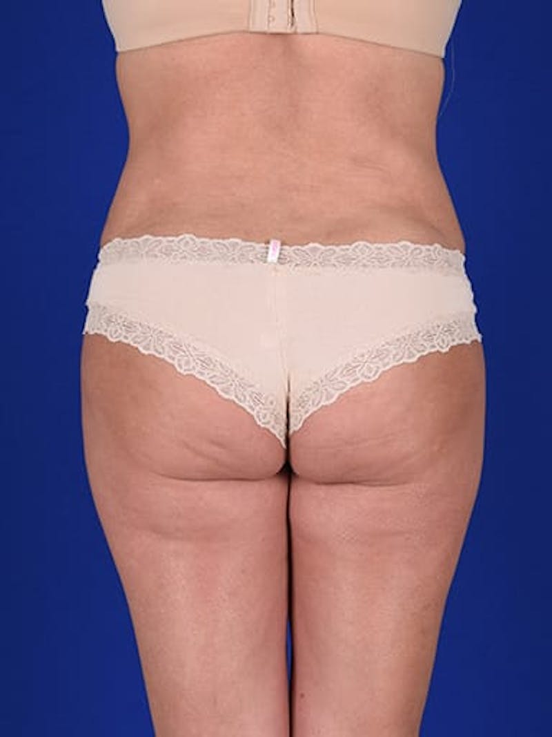 Abdominoplasty / Tummy Tuck Before & After Gallery - Patient 18264531 - Image 10