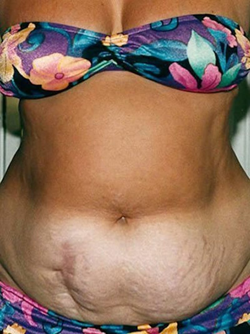 Abdominoplasty / Tummy Tuck Before & After Gallery - Patient 18264534 - Image 1