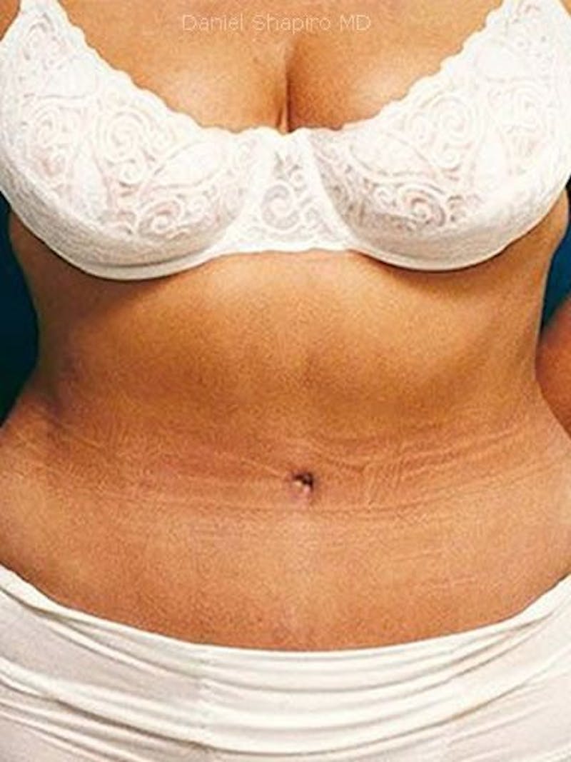 Abdominoplasty / Tummy Tuck Before & After Gallery - Patient 18264534 - Image 2