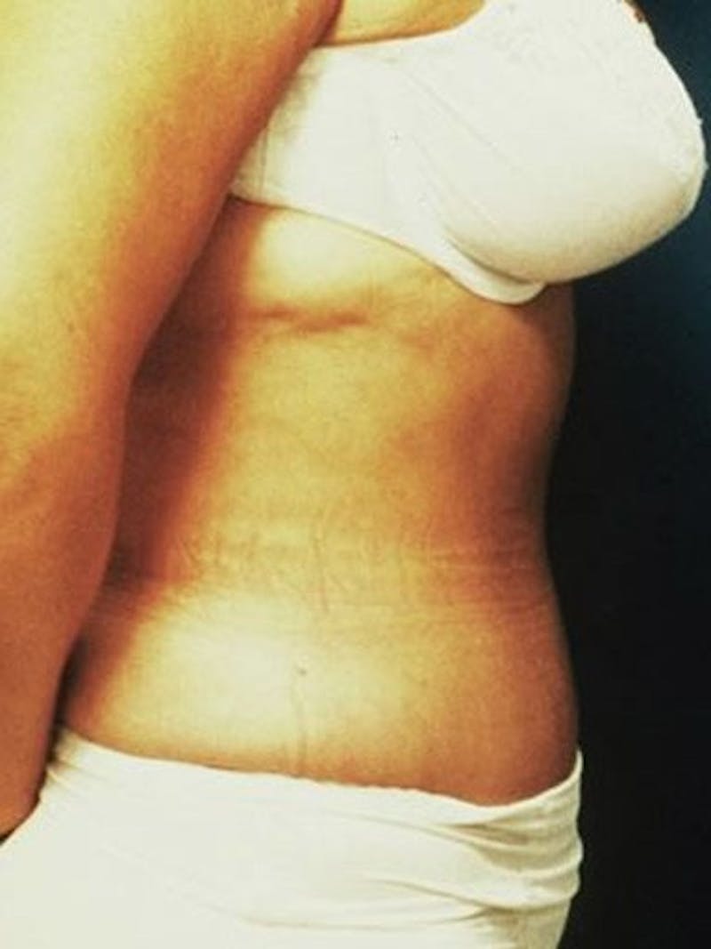 Abdominoplasty / Tummy Tuck Before & After Gallery - Patient 18264534 - Image 3