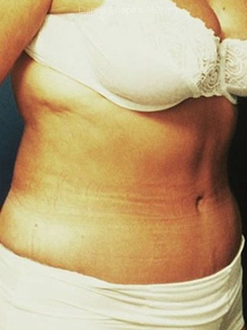 Abdominoplasty / Tummy Tuck Before & After Gallery - Patient 18264534 - Image 4