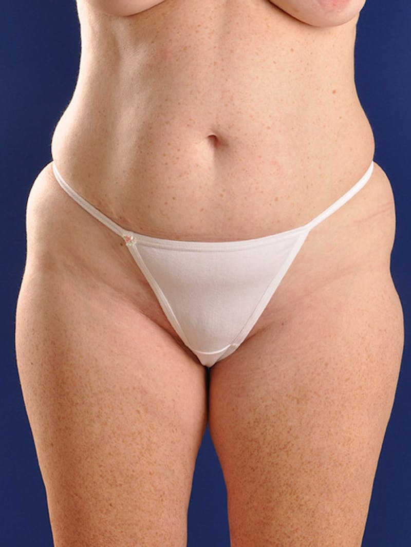 Abdominoplasty / Tummy Tuck Before & After Gallery - Patient 18264538 - Image 1