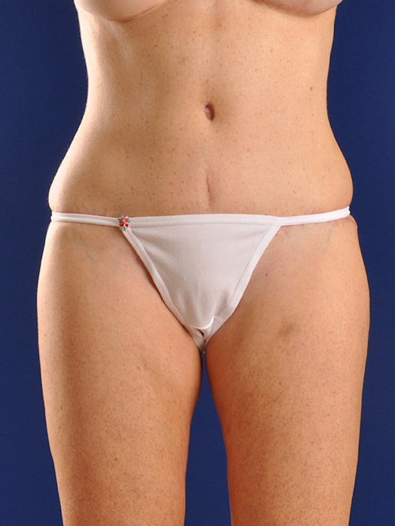 Abdominoplasty / Tummy Tuck Before & After Gallery - Patient 18264538 - Image 2