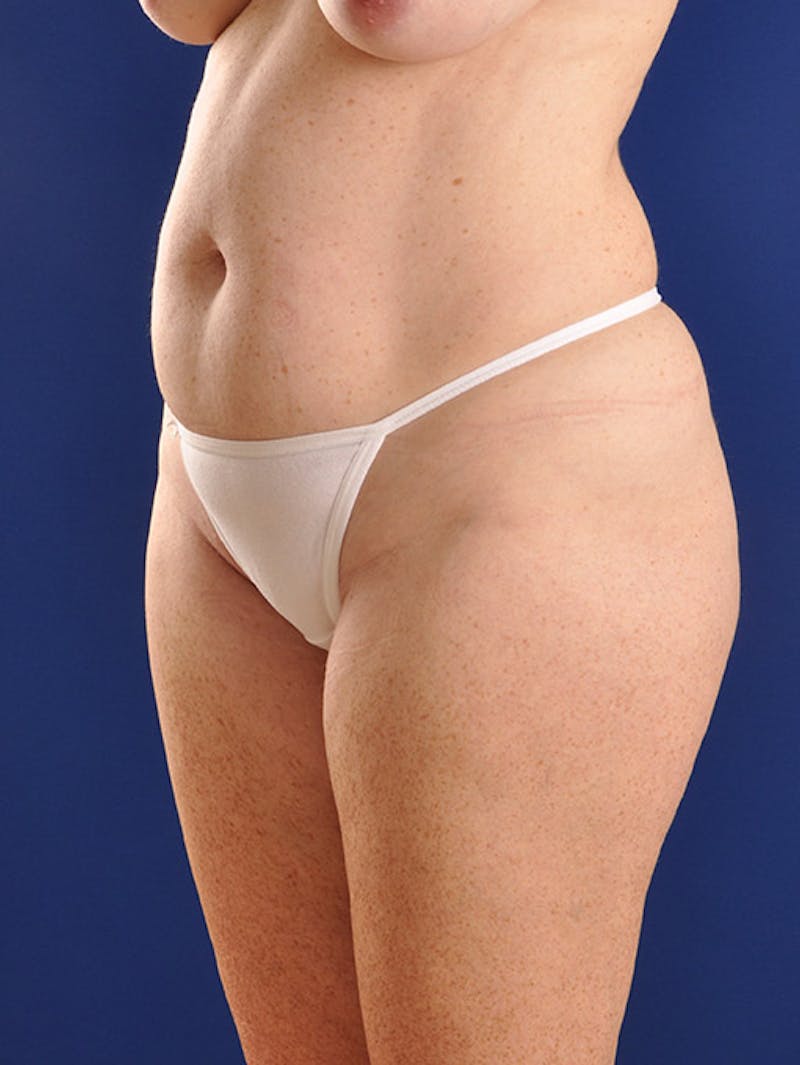 Abdominoplasty / Tummy Tuck Before & After Gallery - Patient 18264538 - Image 3