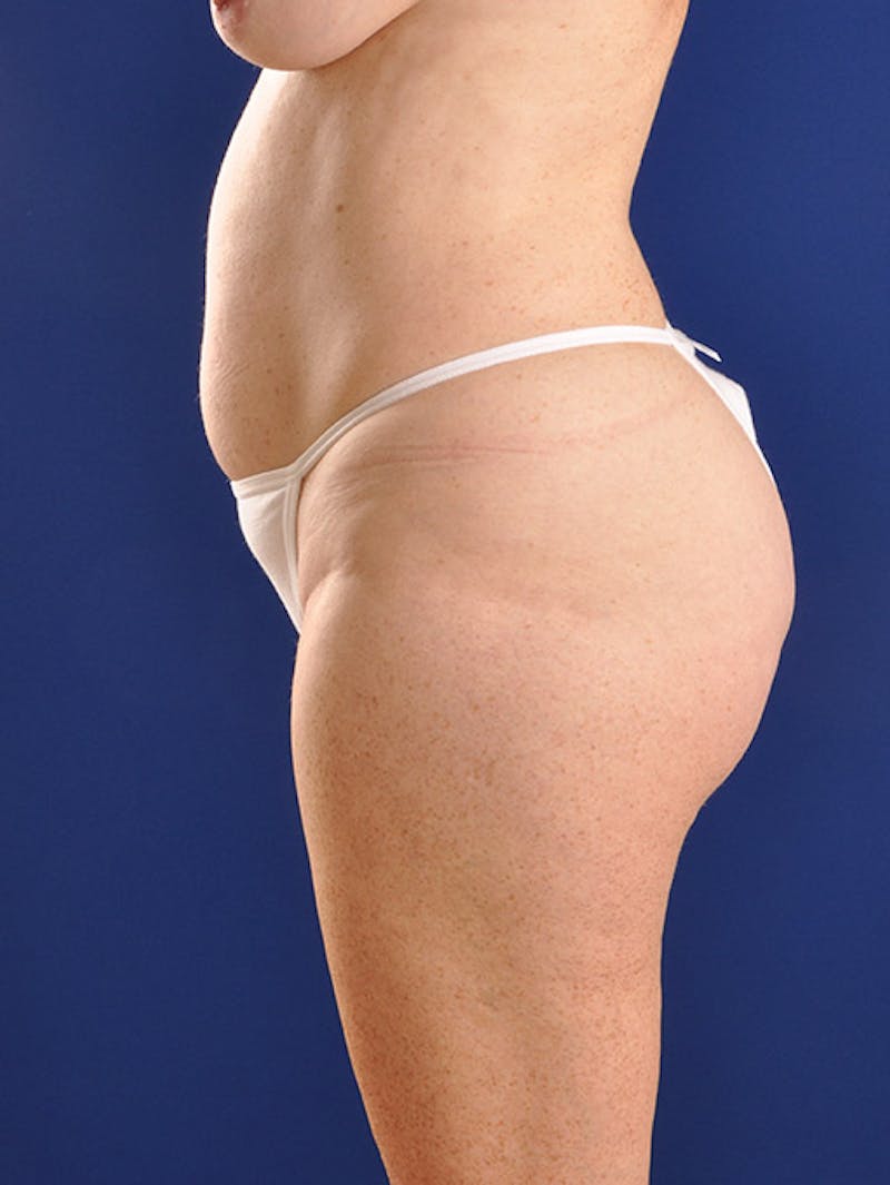 Abdominoplasty / Tummy Tuck Before & After Gallery - Patient 18264538 - Image 5