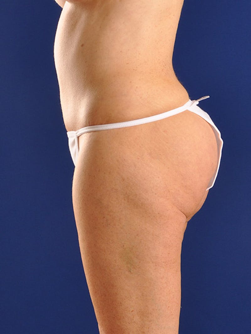 Abdominoplasty / Tummy Tuck Before & After Gallery - Patient 18264538 - Image 6
