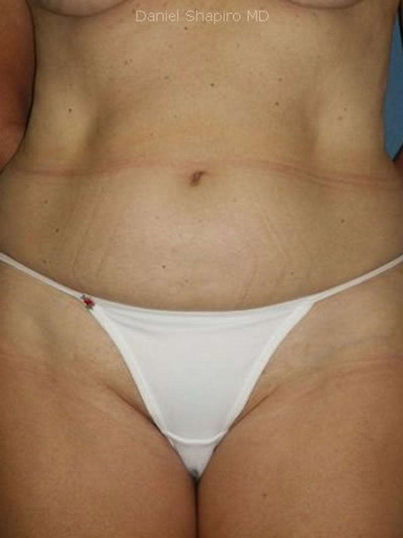 Abdominoplasty / Tummy Tuck Before & After Gallery - Patient 18264542 - Image 1