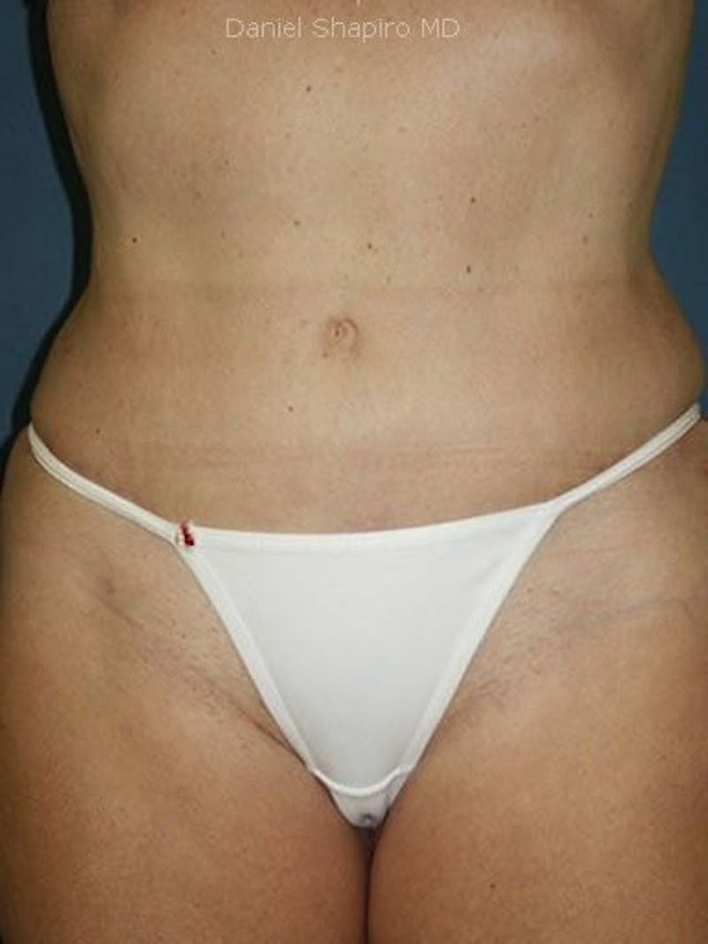 Abdominoplasty / Tummy Tuck Before & After Gallery - Patient 18264542 - Image 2
