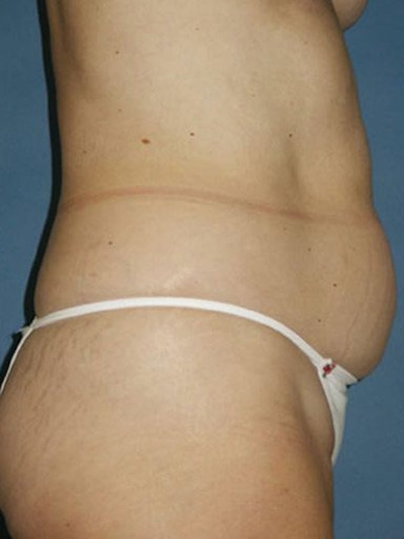Abdominoplasty / Tummy Tuck Before & After Gallery - Patient 18264542 - Image 3