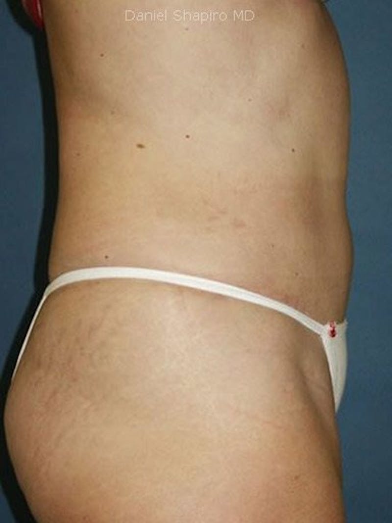 Abdominoplasty / Tummy Tuck Before & After Gallery - Patient 18264542 - Image 4