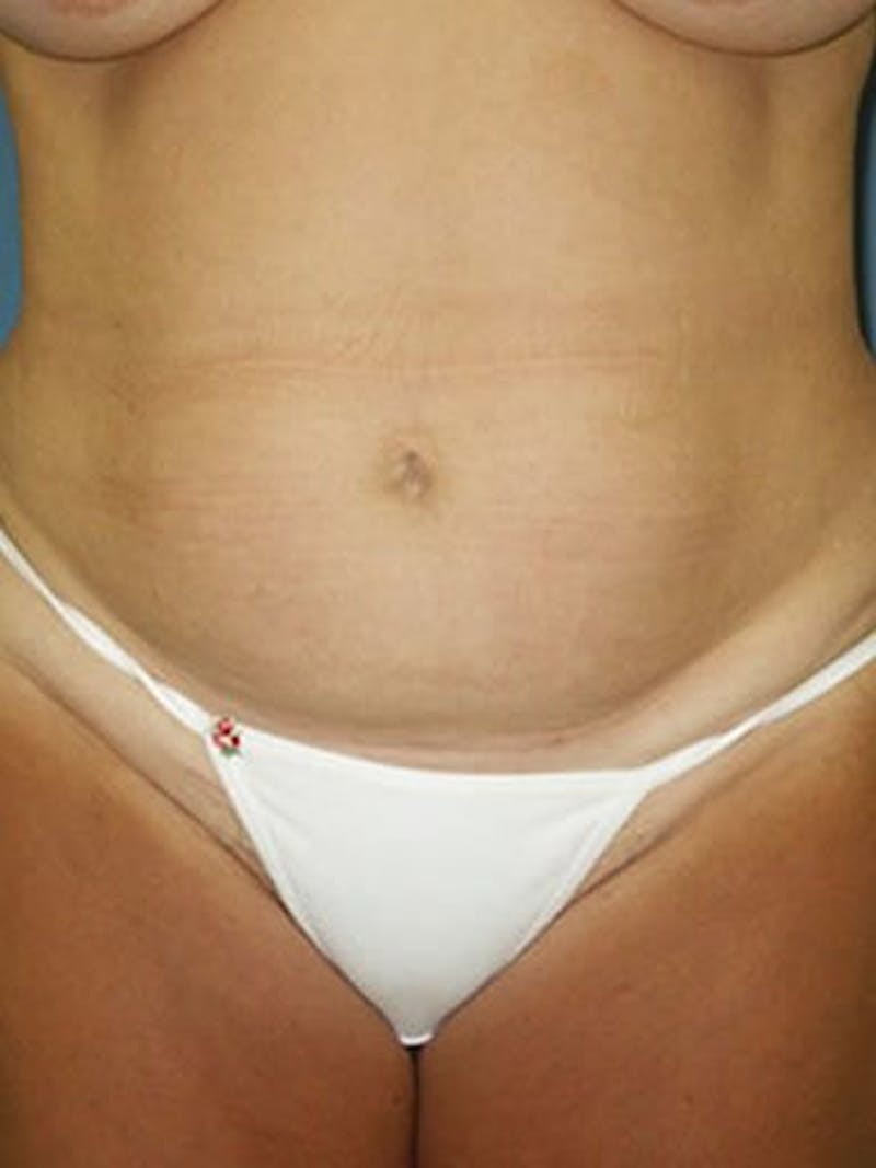 Abdominoplasty / Tummy Tuck Before & After Gallery - Patient 18264549 - Image 1