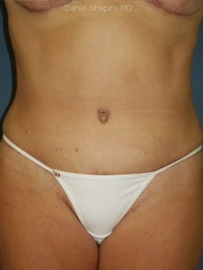 Abdominoplasty / Tummy Tuck Before & After Gallery - Patient 18264549 - Image 2