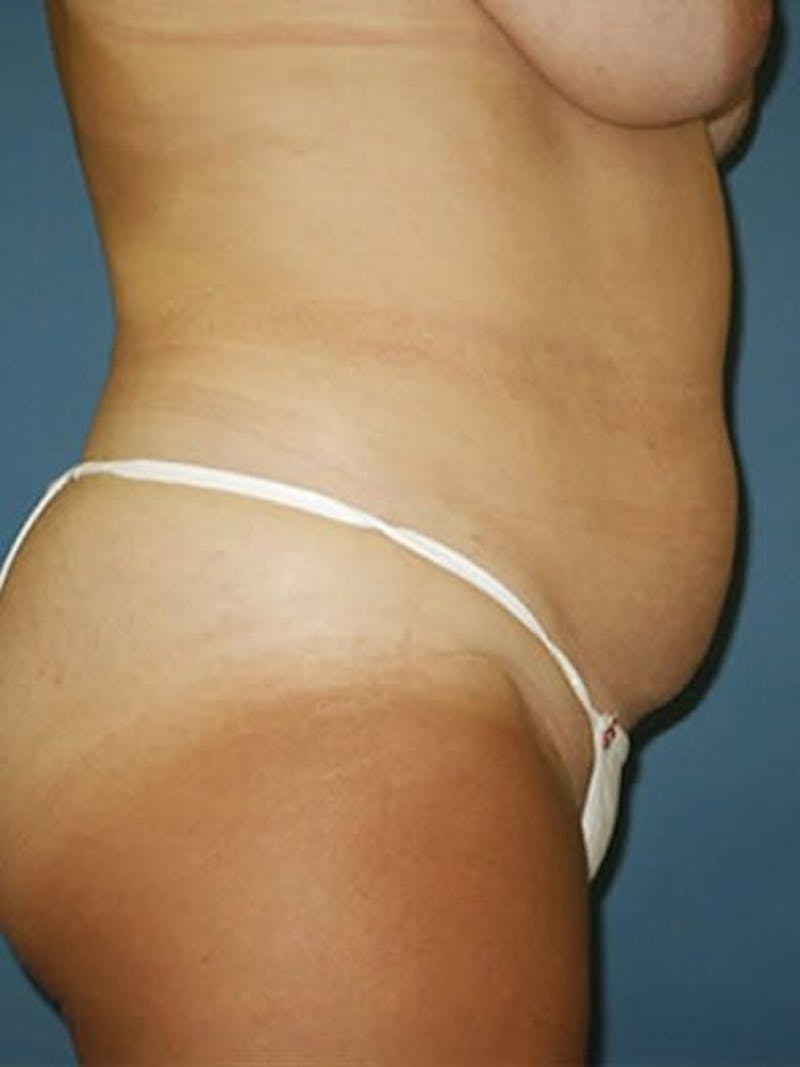 Abdominoplasty / Tummy Tuck Before & After Gallery - Patient 18264549 - Image 3