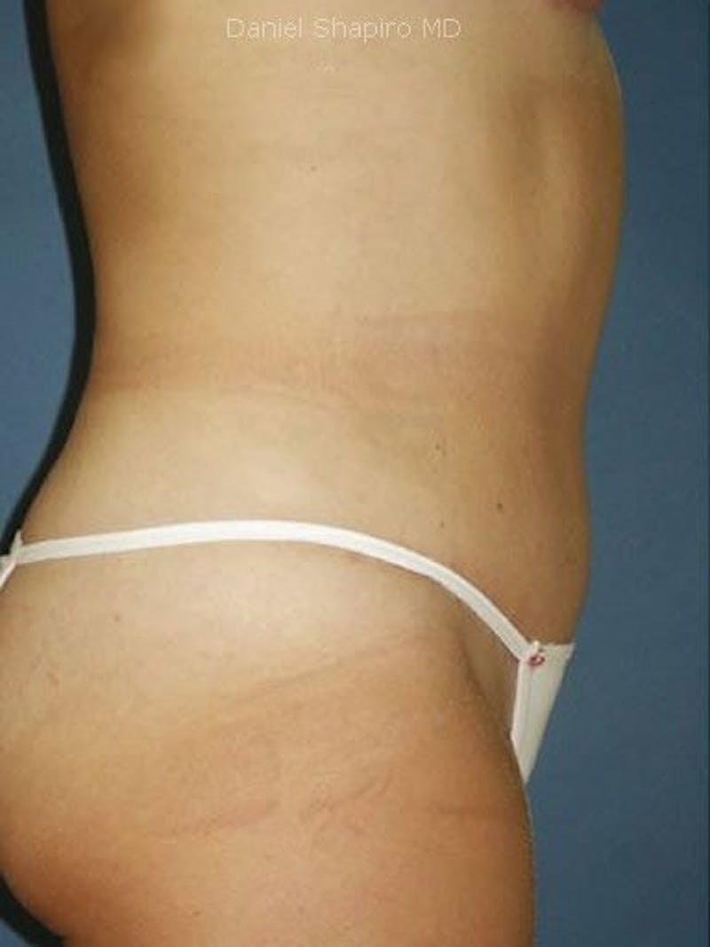Abdominoplasty / Tummy Tuck Before & After Gallery - Patient 18264549 - Image 4