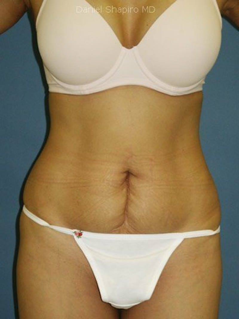 Abdominoplasty / Tummy Tuck Before & After Gallery - Patient 18264553 - Image 1
