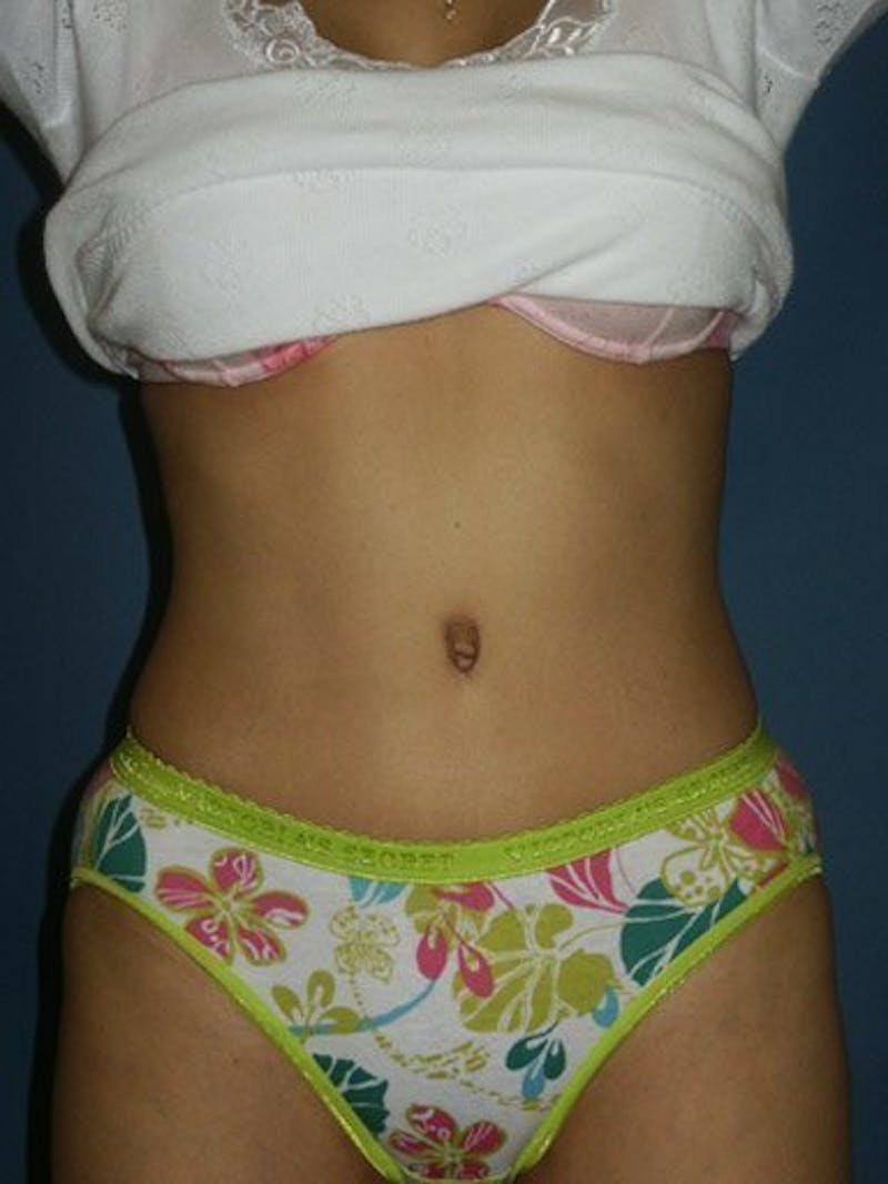 Abdominoplasty / Tummy Tuck Before & After Gallery - Patient 18264553 - Image 2