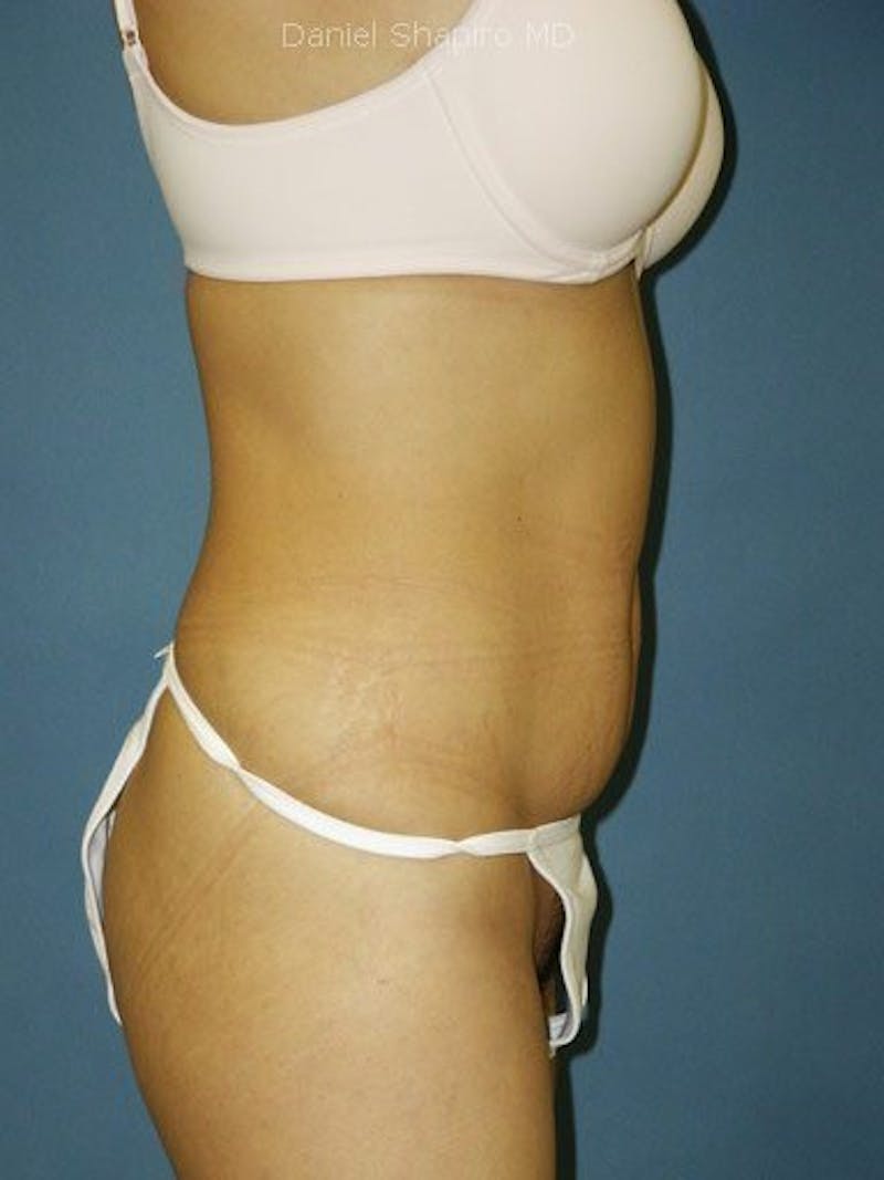 Abdominoplasty / Tummy Tuck Before & After Gallery - Patient 18264553 - Image 3