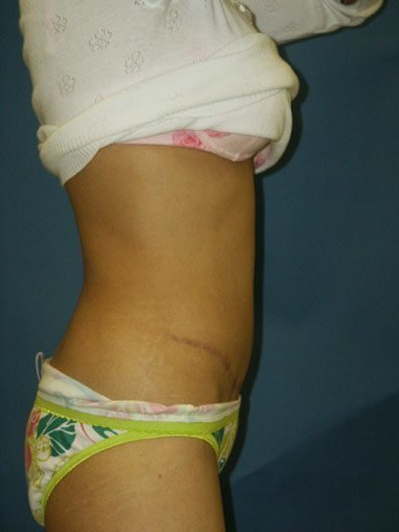 Abdominoplasty / Tummy Tuck Before & After Gallery - Patient 18264553 - Image 4