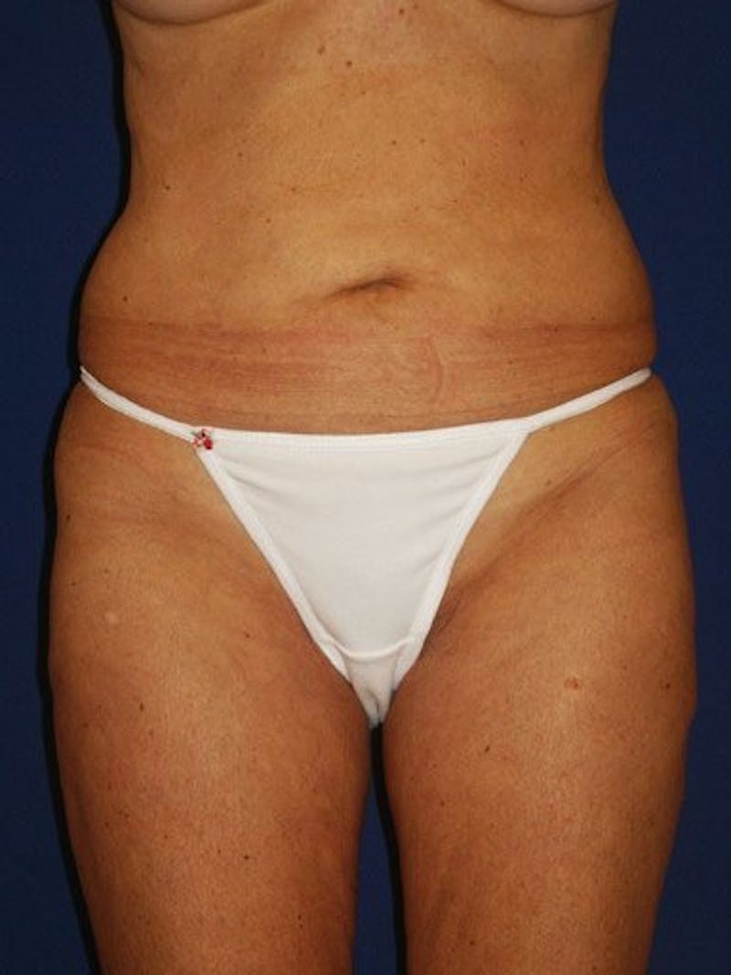 Abdominoplasty / Tummy Tuck Before & After Gallery - Patient 18264558 - Image 1