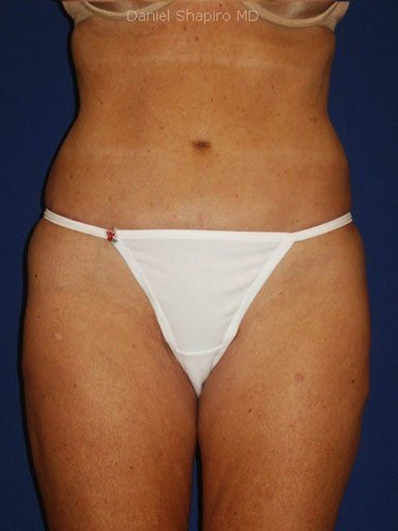 Abdominoplasty / Tummy Tuck Before & After Gallery - Patient 18264558 - Image 2