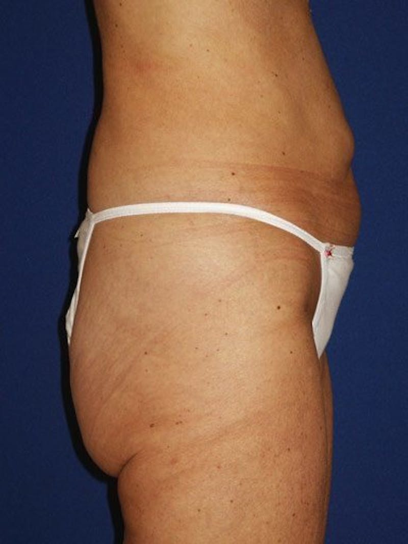Abdominoplasty / Tummy Tuck Before & After Gallery - Patient 18264558 - Image 3