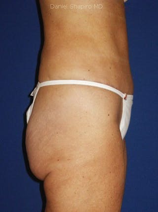 Abdominoplasty / Tummy Tuck Before & After Gallery - Patient 18264558 - Image 4