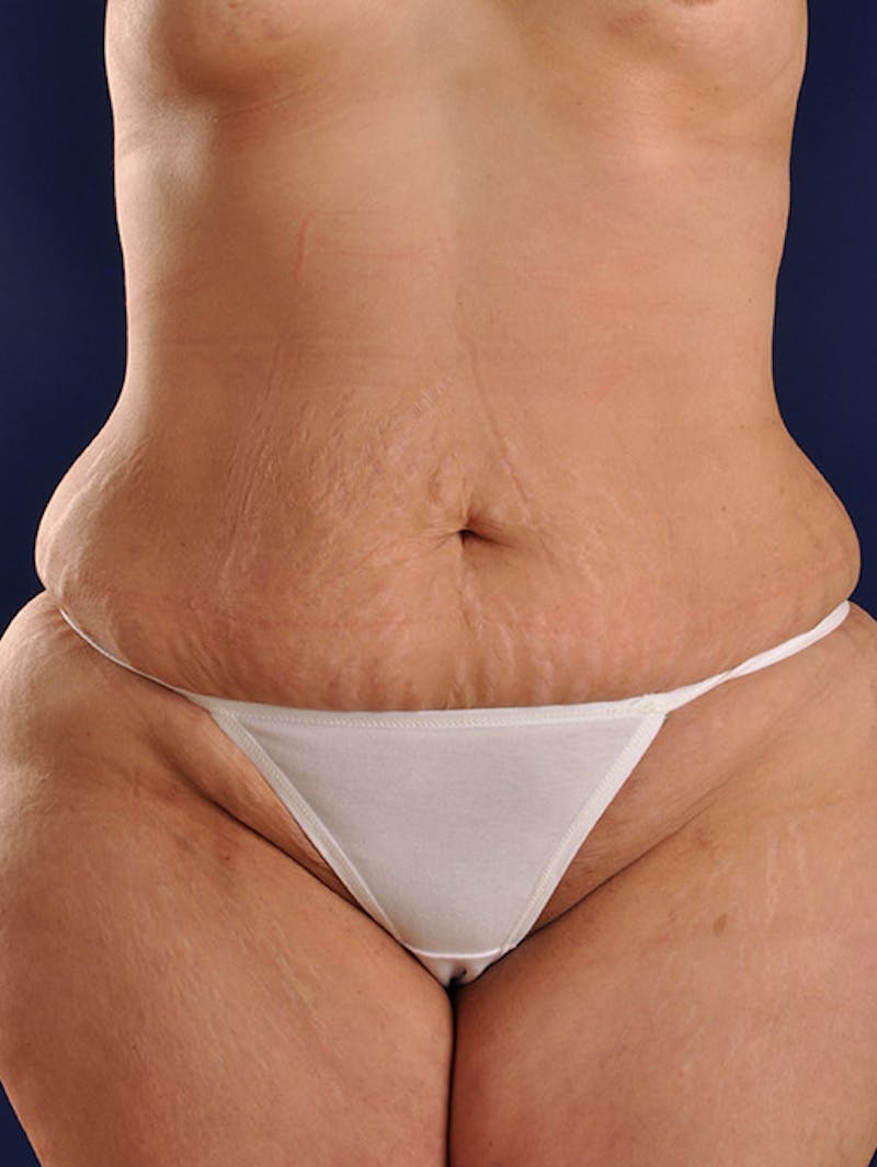 Abdominoplasty / Tummy Tuck Before & After Gallery - Patient 18264563 - Image 1