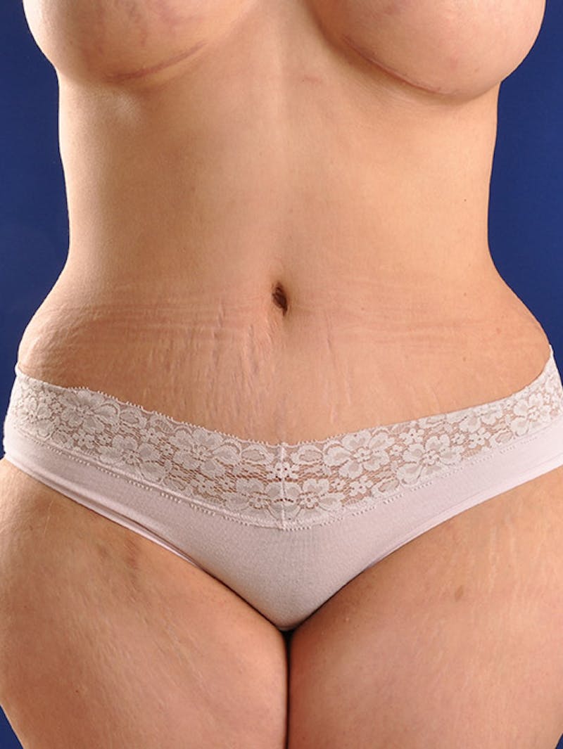 Abdominoplasty / Tummy Tuck Before & After Gallery - Patient 18264563 - Image 2