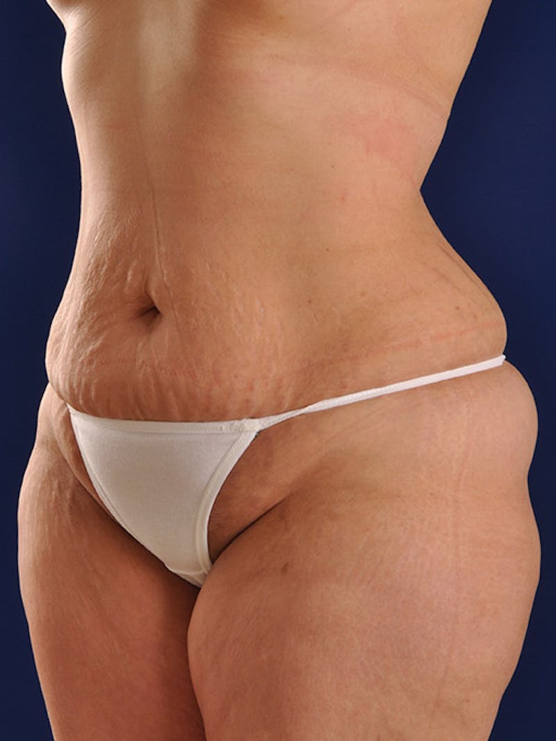 Abdominoplasty / Tummy Tuck Before & After Gallery - Patient 18264563 - Image 3