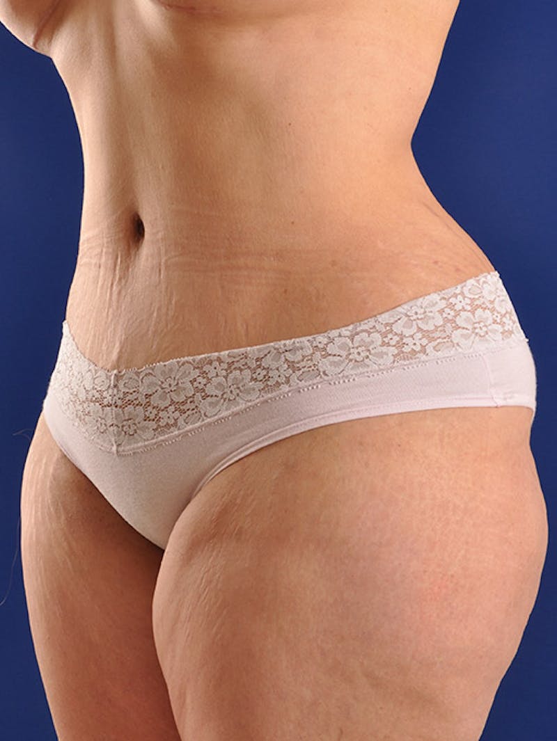 Abdominoplasty / Tummy Tuck Before & After Gallery - Patient 18264563 - Image 4
