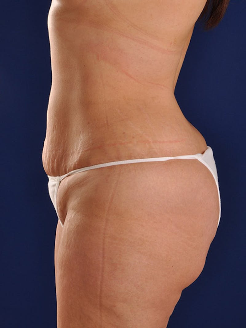 Abdominoplasty / Tummy Tuck Before & After Gallery - Patient 18264563 - Image 5