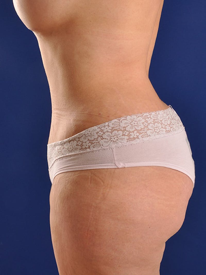 Abdominoplasty / Tummy Tuck Before & After Gallery - Patient 18264563 - Image 6