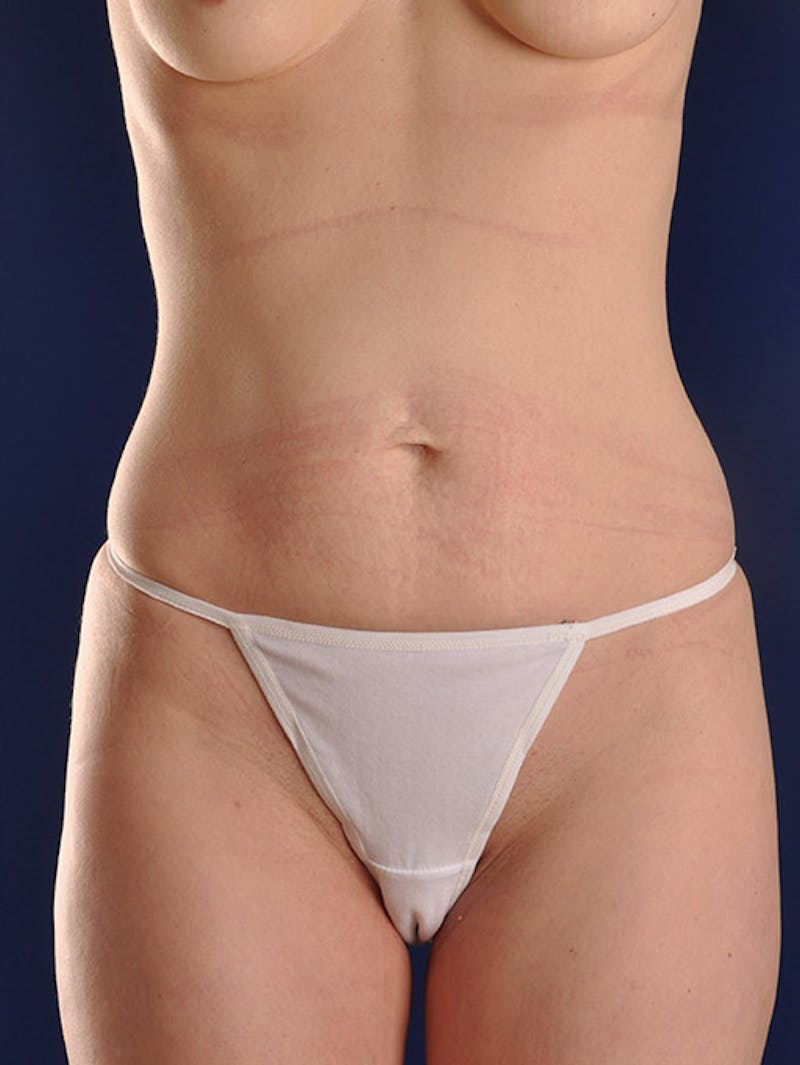 Abdominoplasty / Tummy Tuck Before & After Gallery - Patient 18264564 - Image 1
