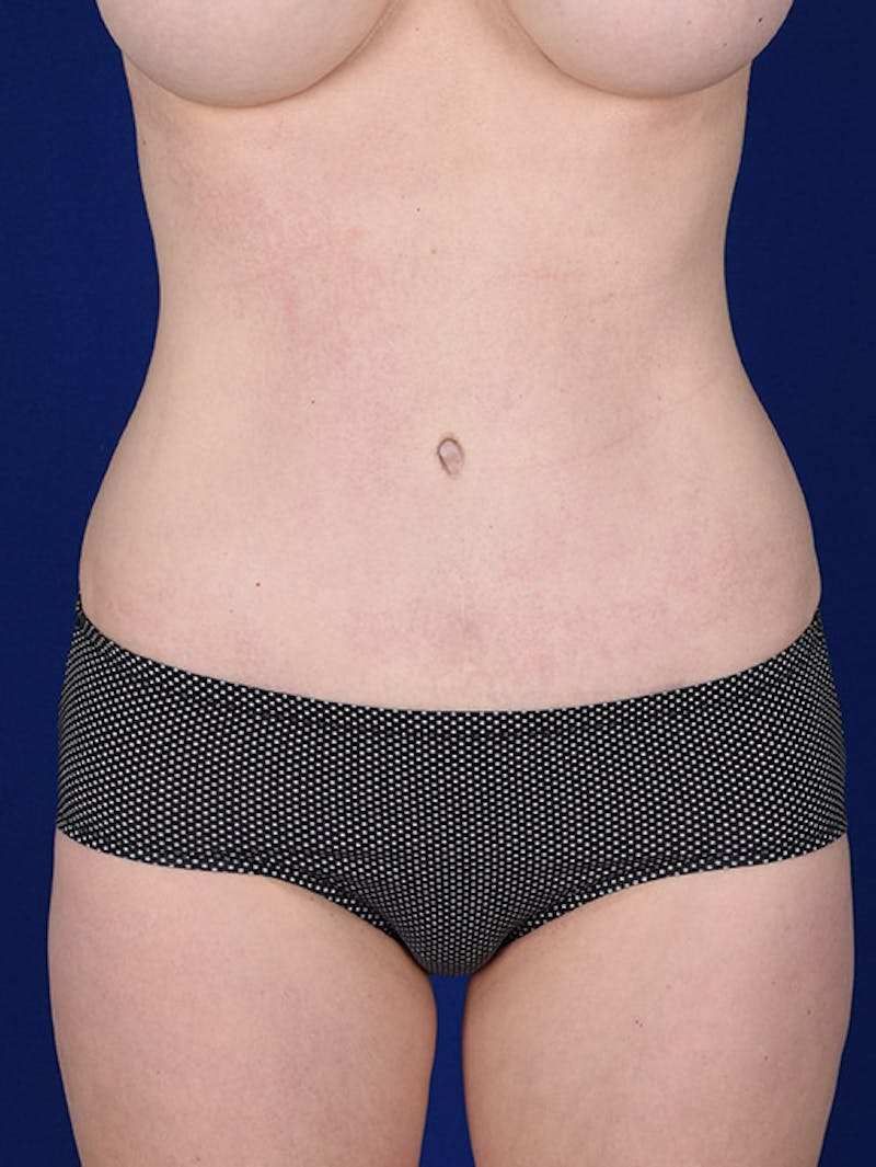 Abdominoplasty / Tummy Tuck Before & After Gallery - Patient 18264564 - Image 2