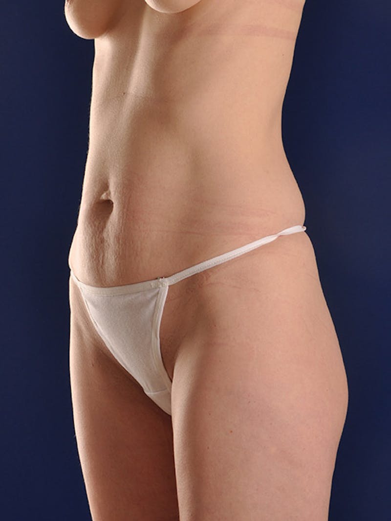 Abdominoplasty / Tummy Tuck Before & After Gallery - Patient 18264564 - Image 3