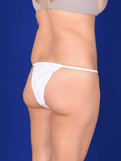 Fat Transfer Buttocks (Brazilian Butt Lift) Before & After Gallery - Patient 18264574 - Image 1
