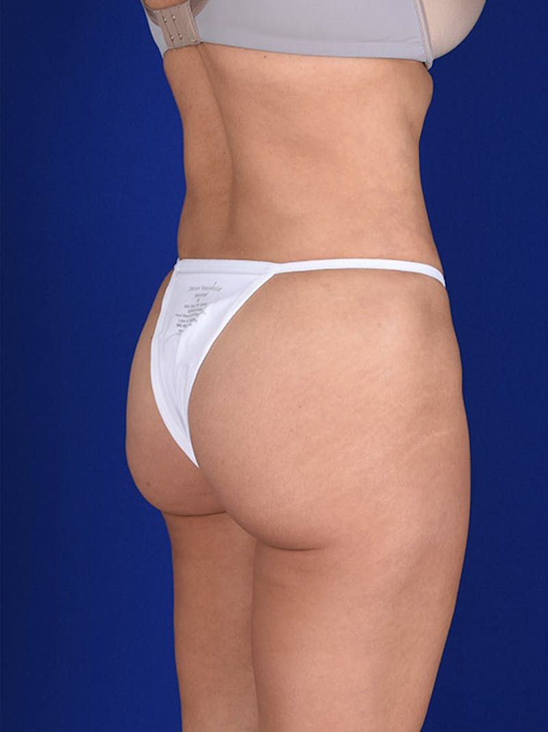 Fat Transfer Buttocks (Brazilian Butt Lift) Before & After Gallery - Patient 18264574 - Image 2