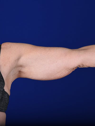 Arms Before & After Gallery - Patient 18264578 - Image 1