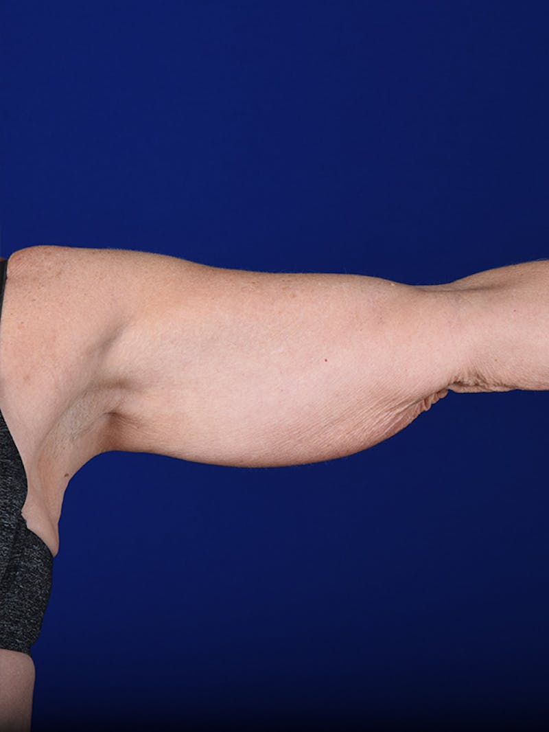 Arms Before & After Gallery - Patient 18264578 - Image 1