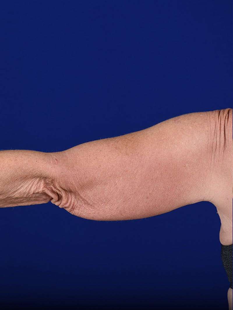 Arms Before & After Gallery - Patient 18264578 - Image 3