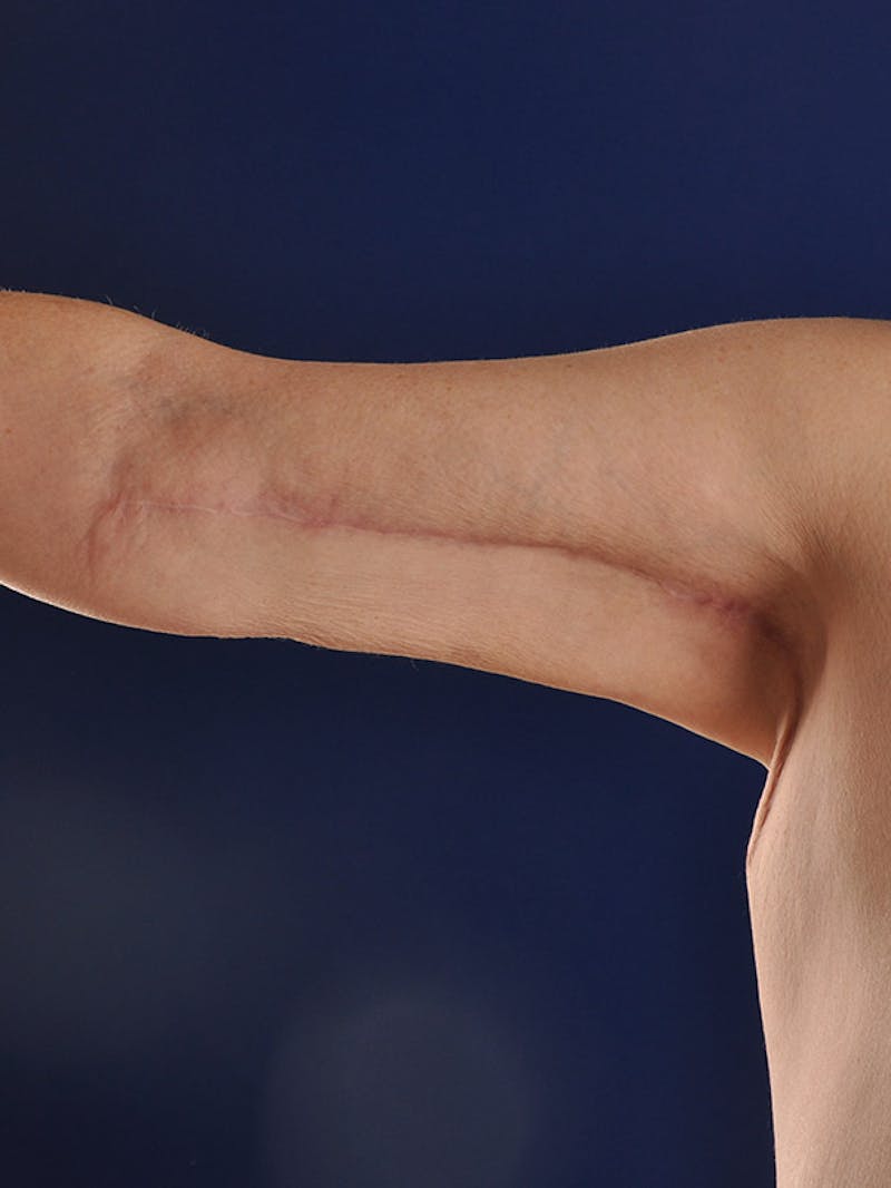 Arms Before & After Gallery - Patient 18264583 - Image 2