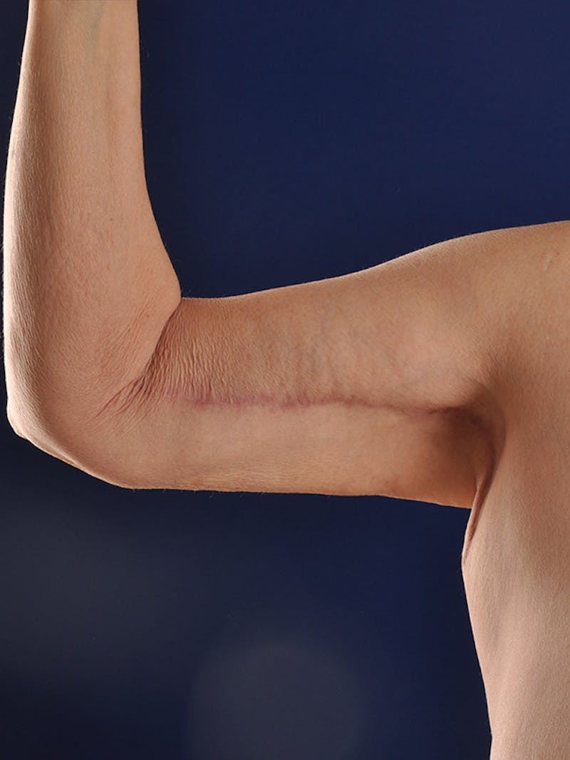 Arms Before & After Gallery - Patient 18264583 - Image 4